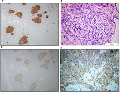 Nesidioblastosis and Insulinoma: A Rare Coexistence and a Therapeutic Challenge